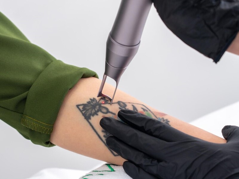 Close-up of a person's arm undergoing laser tattoo removal. A professional's hand, wearing a black glove, holds the arm steady while a laser device targets a black geometric and floral tattoo design.