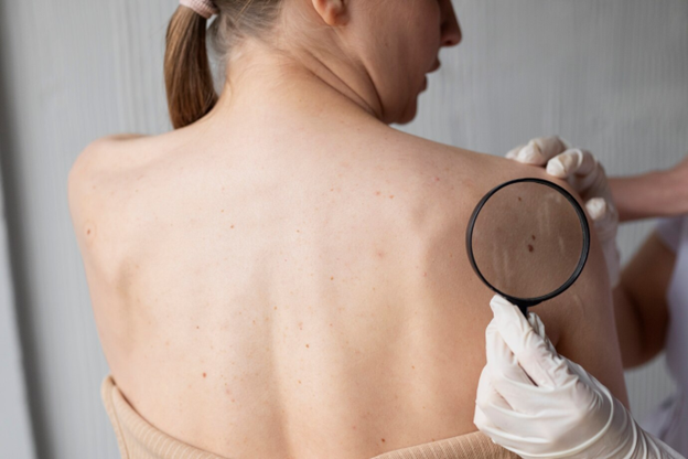 A doctor in white gloves holds a magnifying glass over a patient's back to examine a prominent, dark mole or skin lesion during a dermatological check.