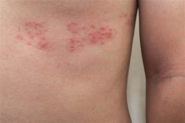 Close-up of a person's torso showing a cluster of red, raised blisters and a rash across the ribs, characteristic of shingles or contact dermatitis.
