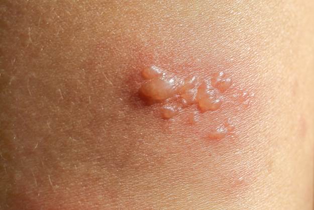 Close-up of human skin showing a cluster of small, clear, fluid-filled blisters on a red base, characteristic of herpes, shingles, or contact dermatitis.