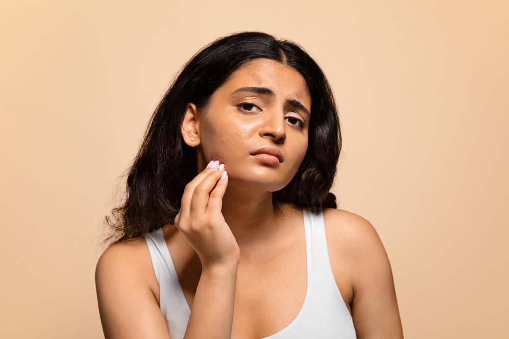 A young woman with dark hair and a distressed expression touches a patch of dry or irritated skin on her cheek, suggesting acne or a rash.